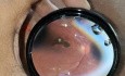 Toxoplasmosis Retinal Scar 