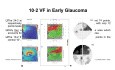 Did You Know Series: Why Visual Field 24-2 Alone Might Be Failing Your Glaucoma Patients