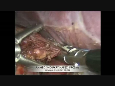 Right Adrenal Mass In a 4 Year Old Child