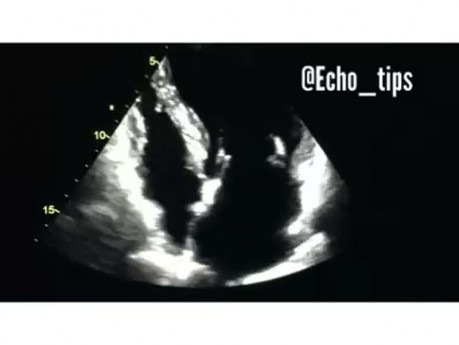 4. Echocardiography Case - What You See?
