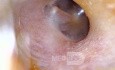 Dermoid Cyst - Comments?
