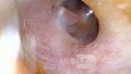 Dermoid Cyst - Comments?