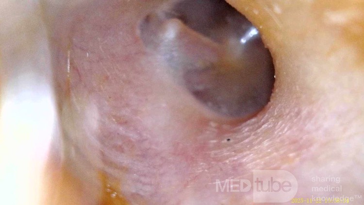 Dermoid Cyst - Comments?