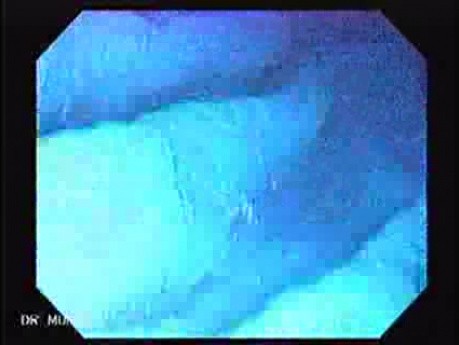 Gastric Folds - Magnifying Endoscope (3 of 8)
