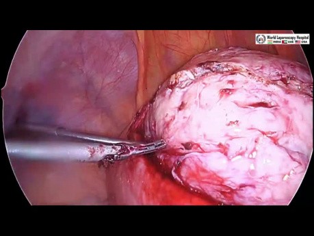 Laparoscopic Myomectomy For Intramural Fibroid