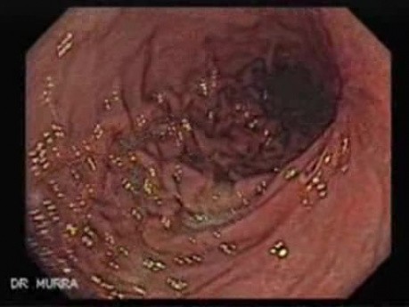Hourglass Stomach - Assessment of the Present Ulcers