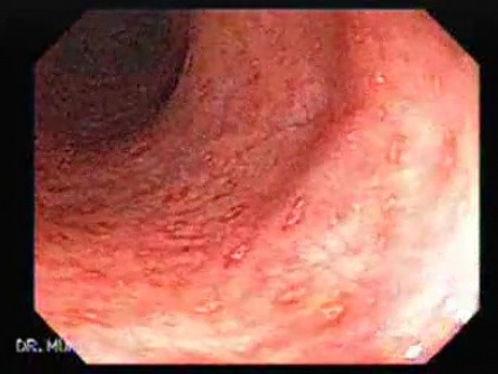 Crohn´s Colitis (3 of 3)