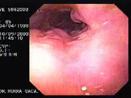 Banding of Esophageal Varices - Scars After Treatment
