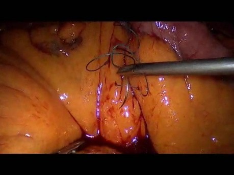 Laparoscopic Gastric Bypass - Part 5
