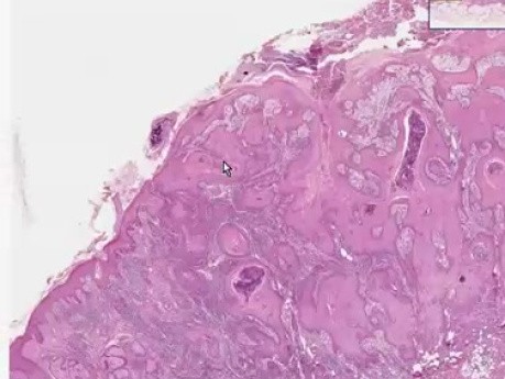 Sikin - Squamous cell carcinoma