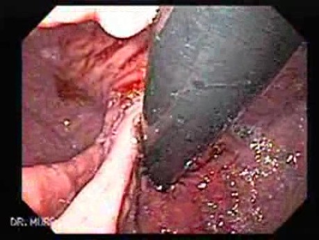 Adenocarcinoma of the Gastroesophageal Junction - Two Hernias