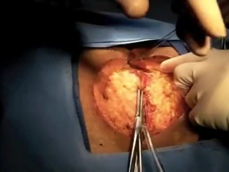 Abdominoperineal Resection with Sacrectomy - with Use of Robotic. Obese Male Patient