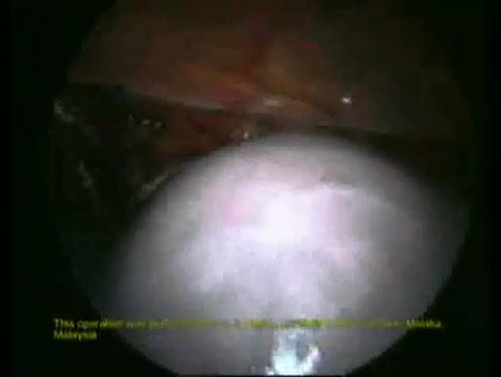 Total Excision of the Uterus - Laparoscopic Method