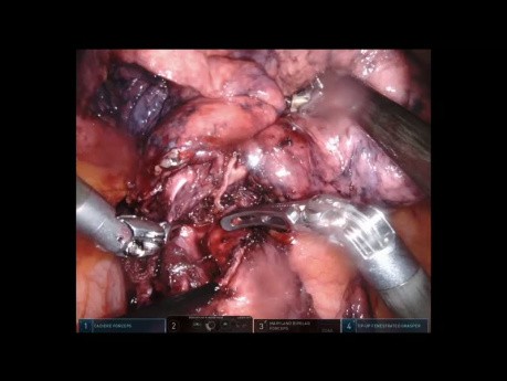 Left Upper Lobe Robotic Resection