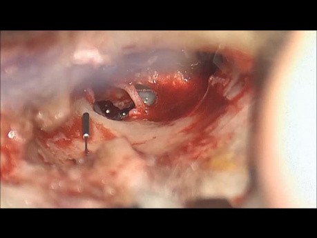 3D Exoscope Diode Laser Stapedotomy