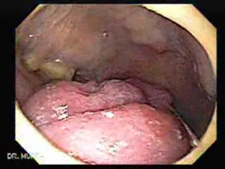 Squamous cell carcinoma of the tongue - exophytic mass(2 of 3)