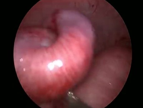 Laparoscopic Reduction of the Ileocolic Intussusception in Infant