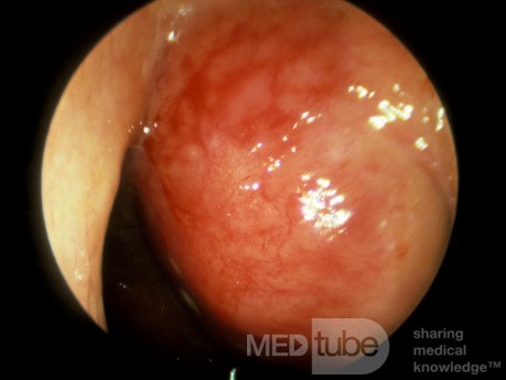 Carcinoma of the Nasopharynx