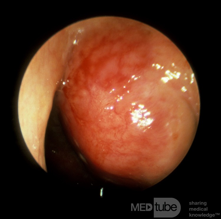 Carcinoma of the Nasopharynx