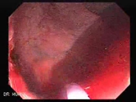 Tubulo - Villous Rectal Adenoma - Endoscopy (15 of 35)