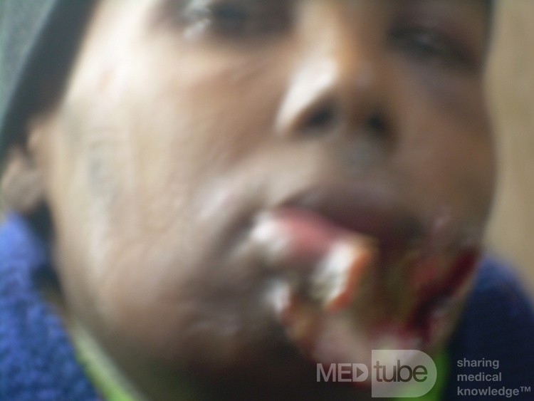 Lip Cancer