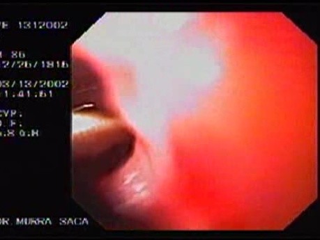 Duodenal Ulcer and Bleeding (4 of 4)