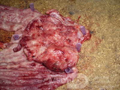 Adenocarcinoma of the cardias and gastric fundus with signet-ring cells (12 of 25)