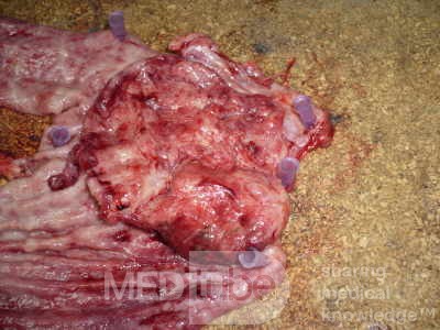 Adenocarcinoma of the cardias and gastric fundus with signet-ring cells (12 of 25)