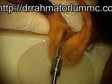 Earwax Removal