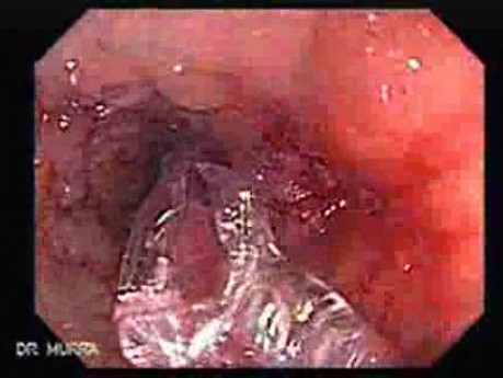 Colonoscopy with Dilation (5 of 8)