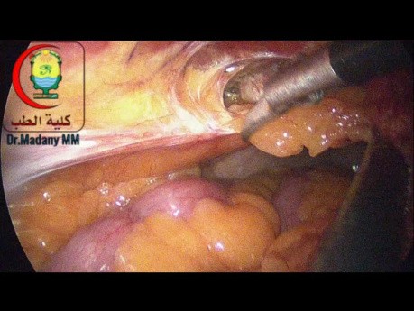 Adhesiolysis for Entrapped Omentum in a Parietal Defect