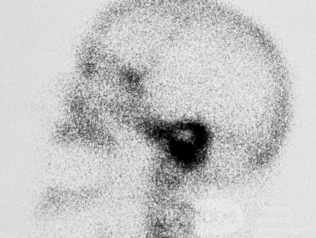 Necrotizing Otitis Extera [Technetium Scan