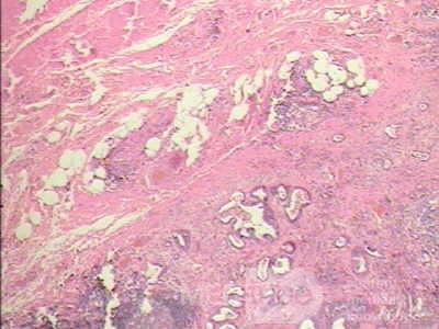 Early Gastric Cancer (18 of 21)