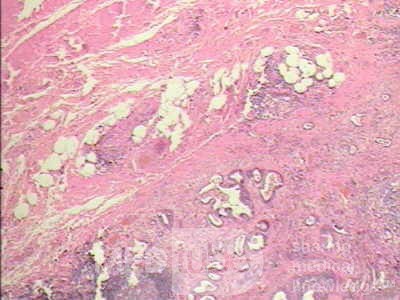 Early Gastric Cancer (18 of 21)