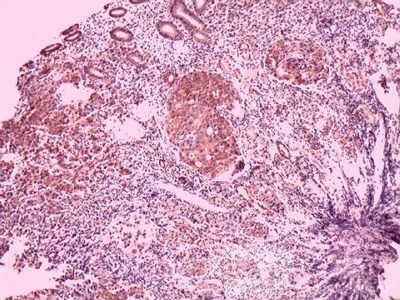 Ovarian Carcinoma Metastatic to Stomach and Duodenum (20 of 20)