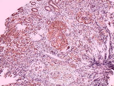 Ovarian Carcinoma Metastatic to Stomach and Duodenum (20 of 20)
