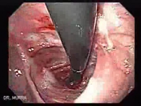 Colonic Interposition for Esophageal Substitution (11 of 11)