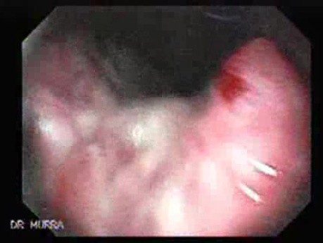 Gastric Adenocarcinoma With Varices - Endoscopy (1 of 8)