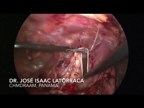 Laparoscopic Resection of Giant Peritoneal Cyst
