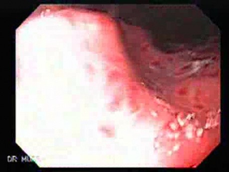 Acute Gastritis (Pangastritis) (2 of 10)