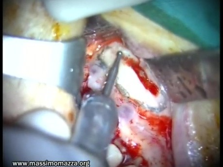 Sinus Lifting (1/2)