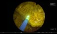 Bladder Stone Lithotripsy with Pulsed Thulium YAG Laser