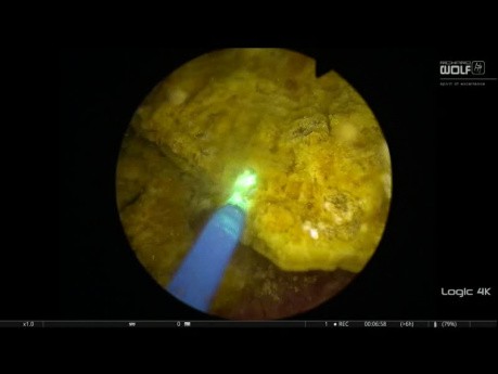Bladder Stone Lithotripsy with Pulsed Thulium YAG Laser