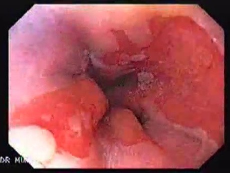 Barrett Esophagus (2 of 6)