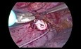 Intrathoracic Stapler Anastomosis