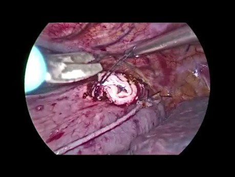 Intrathoracic Stapler Anastomosis