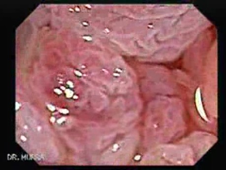 Tubulo-Villous Adenoma (5 of 6)