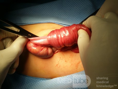 Ileo Ileal Intussusception