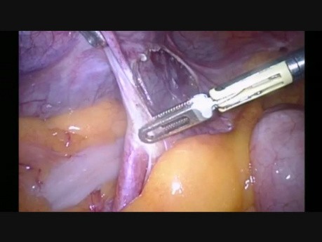 Adnexectomy - 12 cm ovarian tumor