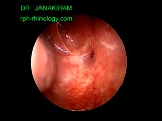 Bilateral Nasal Obstruction